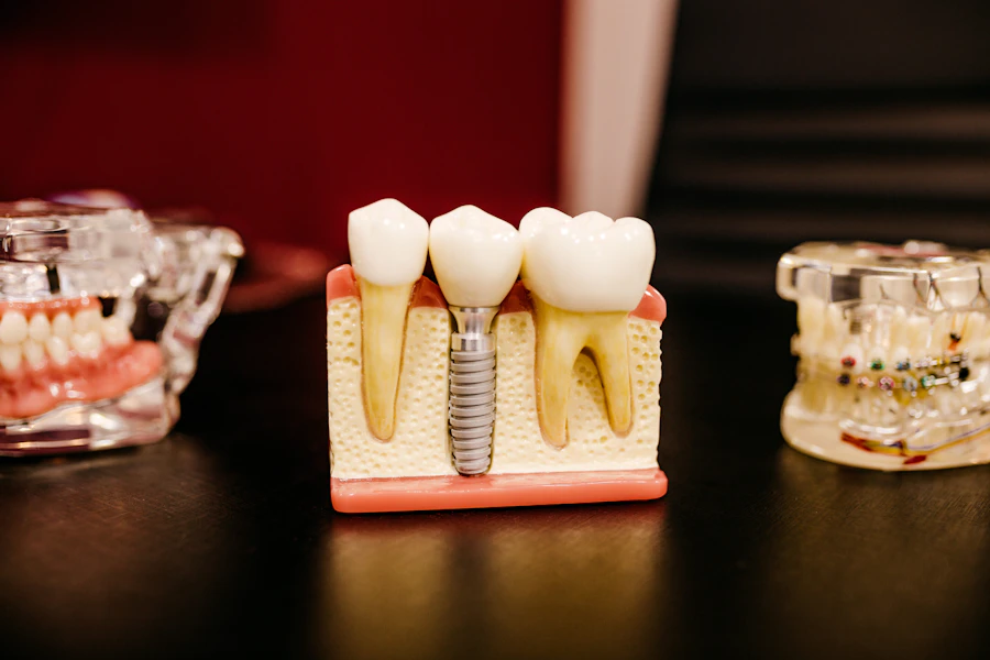 Diş implantının çene kemiği içindeki kesitli modeli
