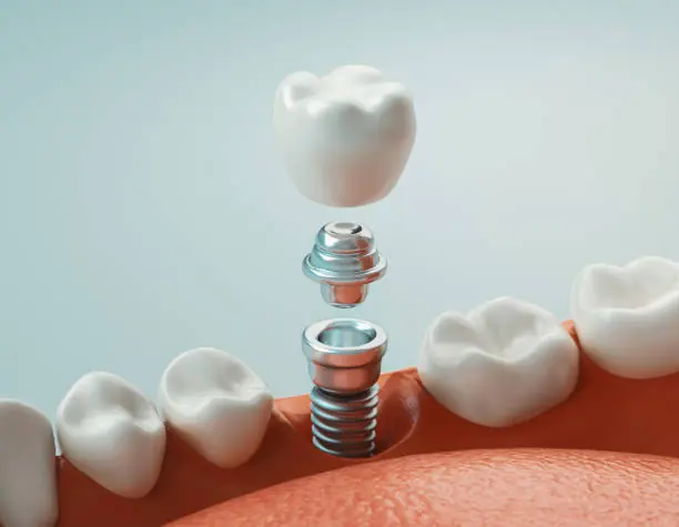 İmplantın yapısını gösteren üç boyutlu çizim: çene kemiğindeki vida, abutment ve kron