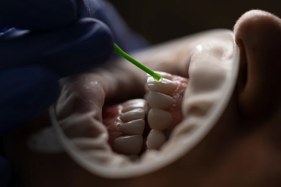 Ağız ekartörü kullanılarak diş yüzeyine kompozit materyal uygulanması